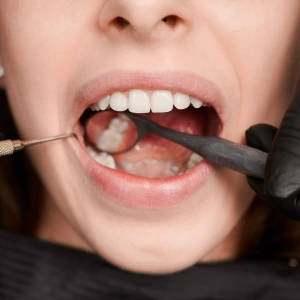 Dental Fillings